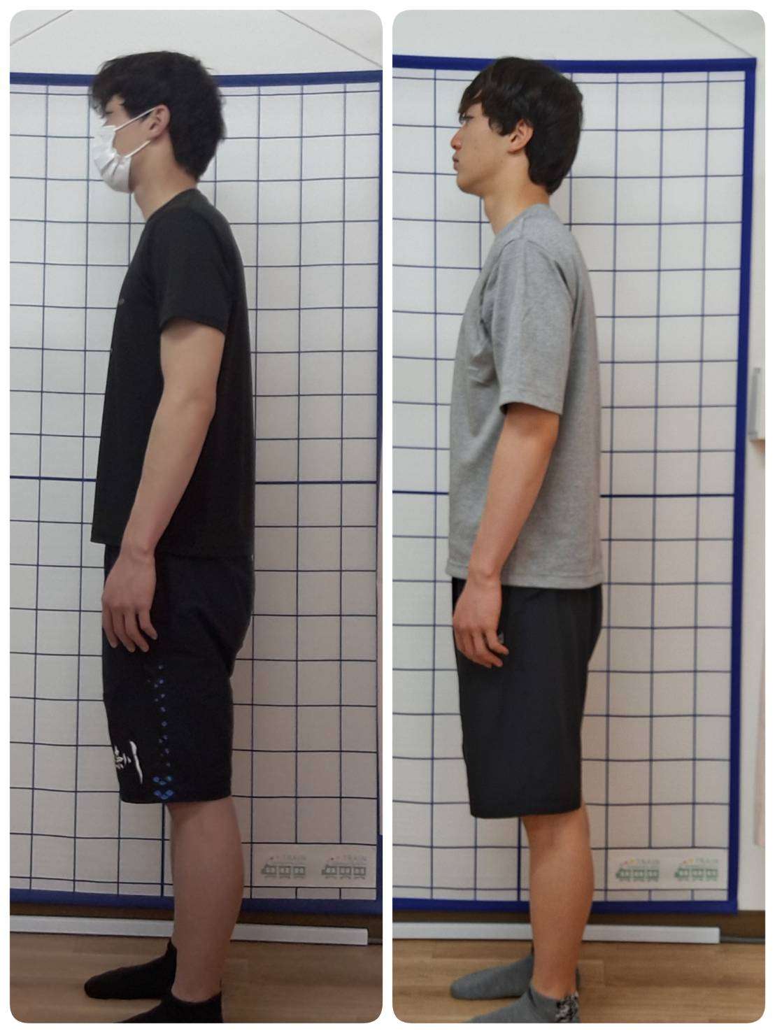 水泳の腰痛/高校3年生経過