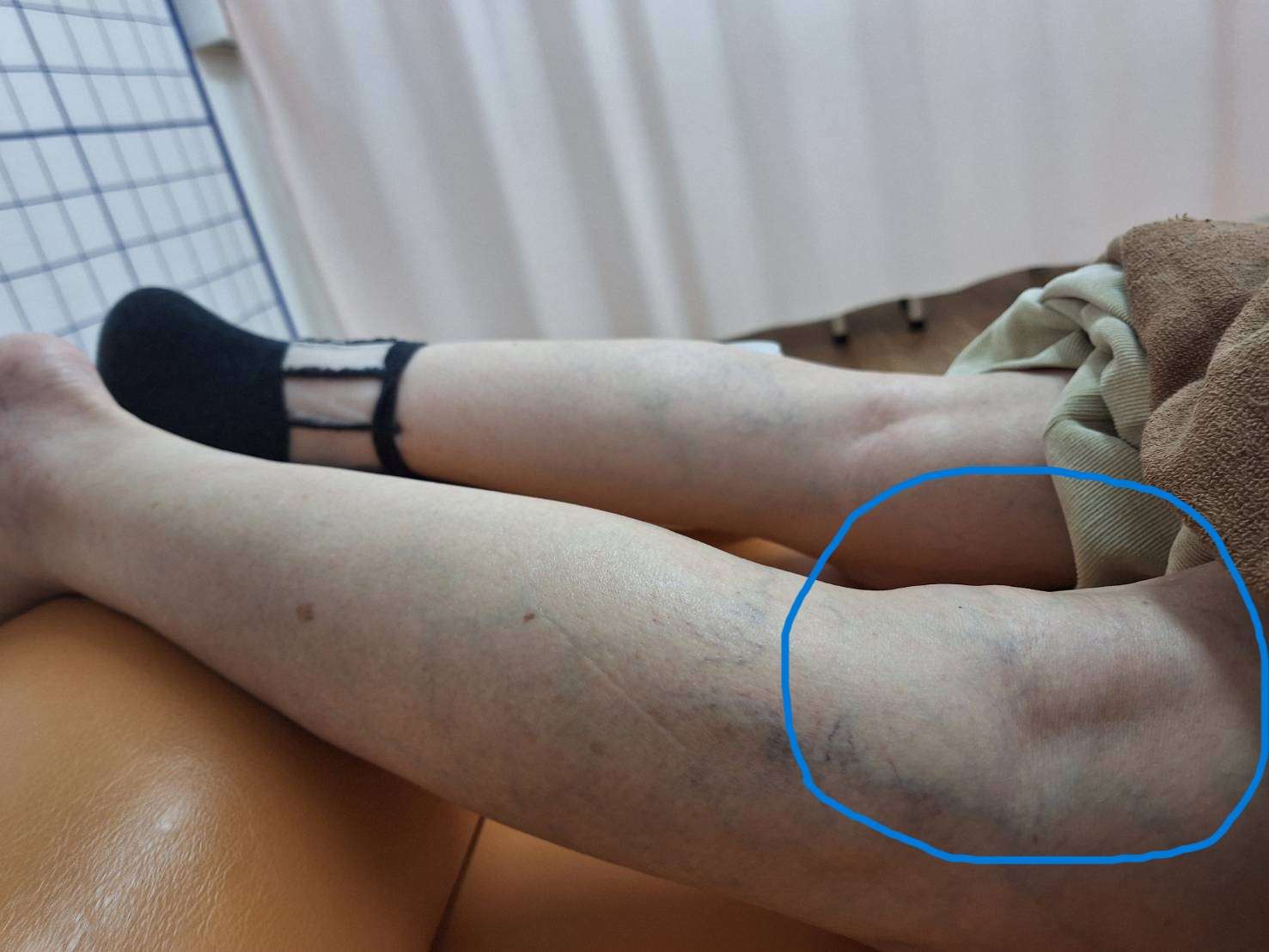 膝の裏が腫れているかも？／ベーカー脳腫　６０代女性